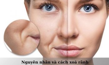 các cách xóa rãnh cười tại nhà hiệu quả