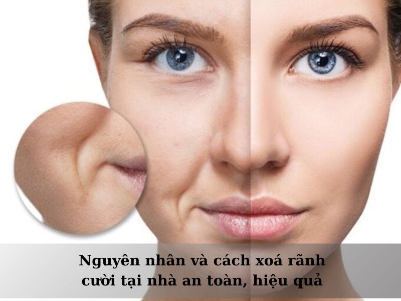 các cách xóa rãnh cười tại nhà hiệu quả